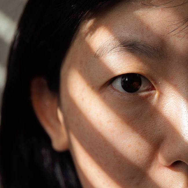 After — Pigmentation laser