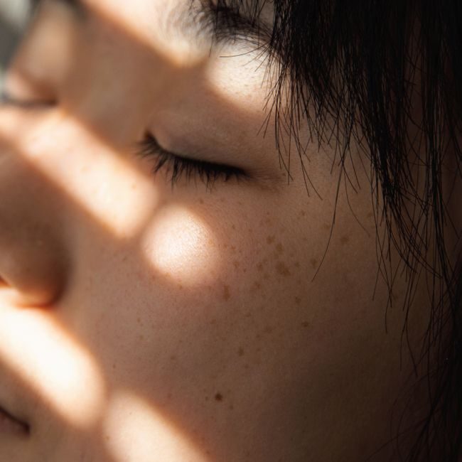 Before — Pigmentation laser